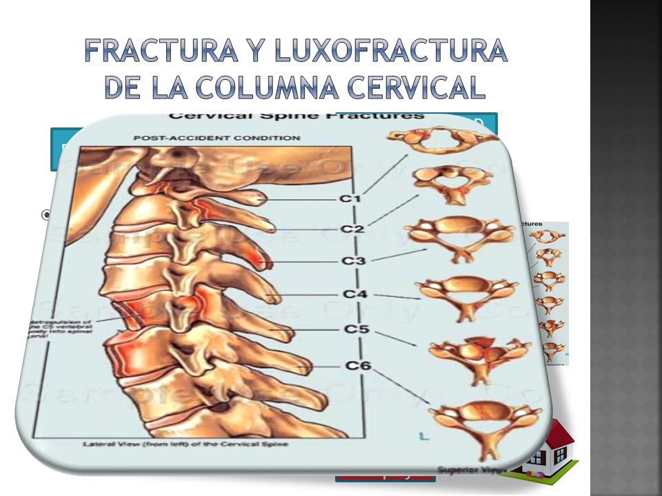 FRACTORA DE COLUMNA CERVICAL EBOOK FRACTORA DE COLUMNA CERVICAL EBOOK